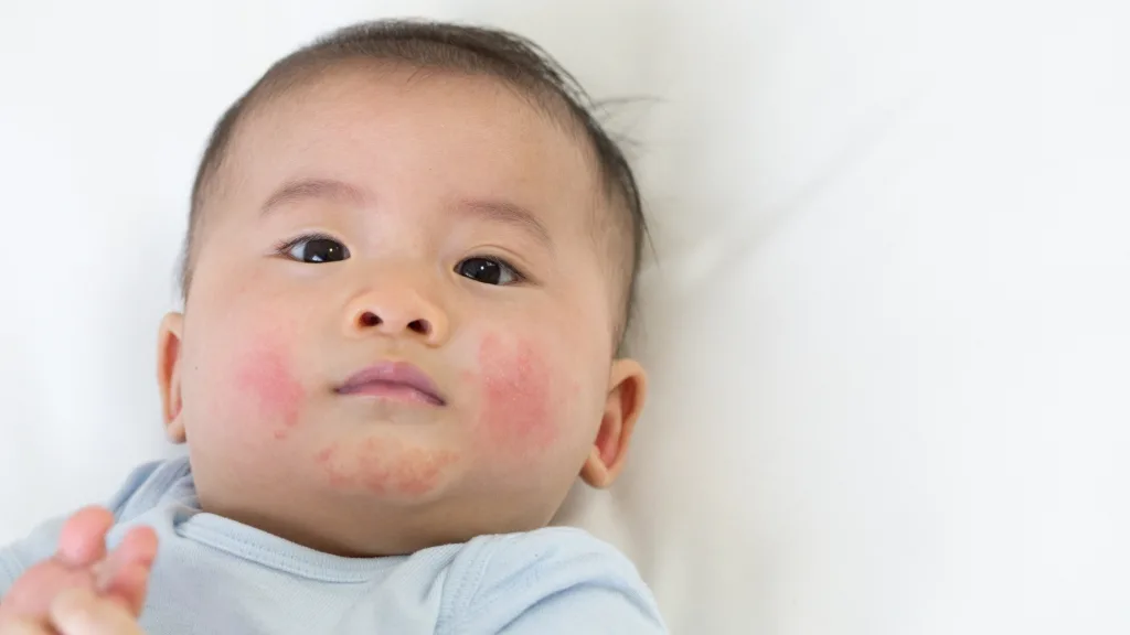 Can Formula Cause Baby Acne? A Guide for New Parents