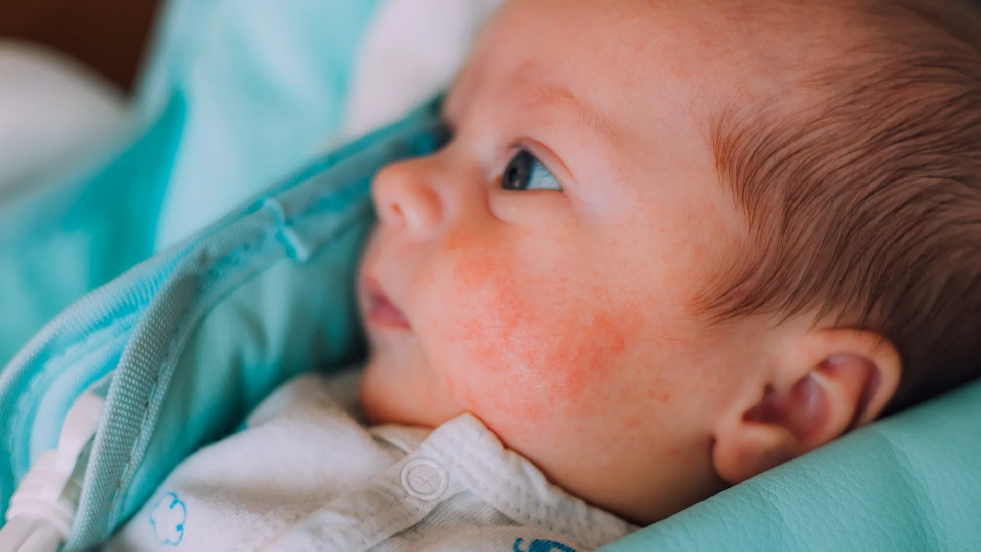 Formula Intolerance vs Formula Allergy: Key Differences 