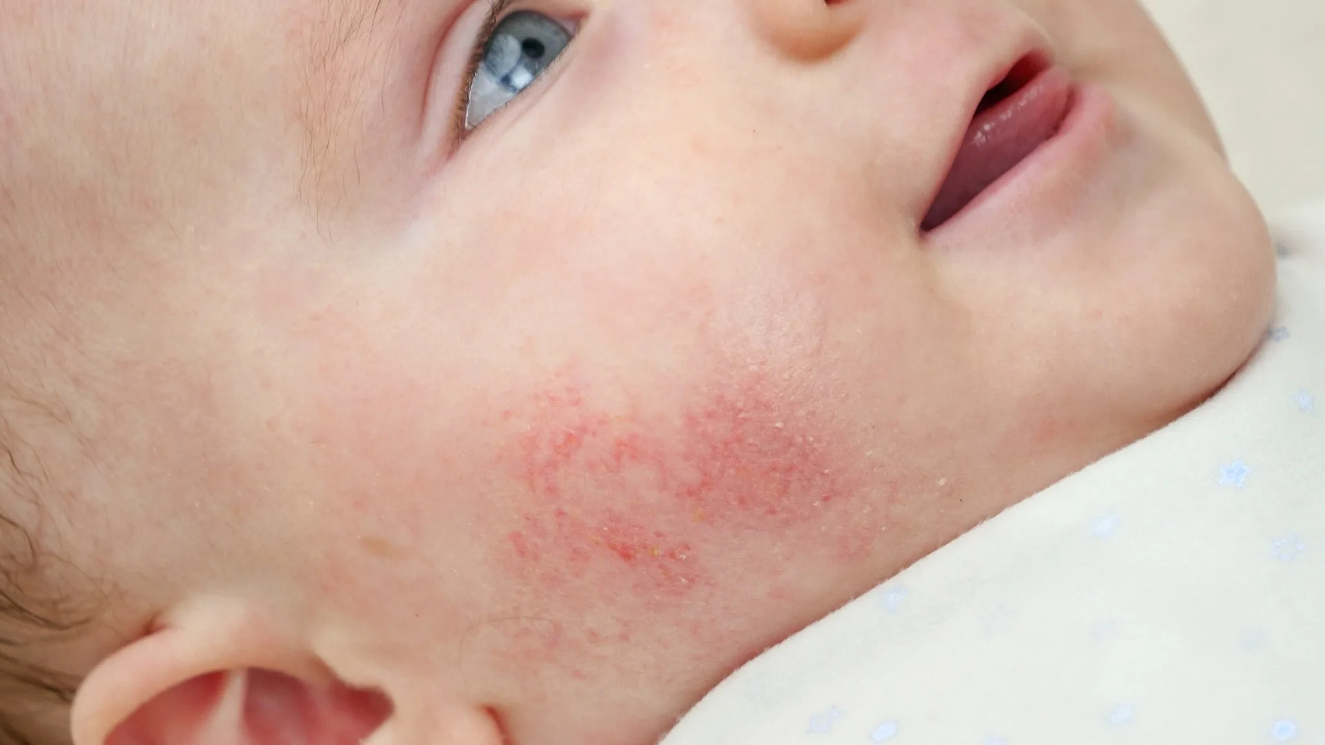 Baby Acne vs Rashes, Allergies, and Other Skin Conditions