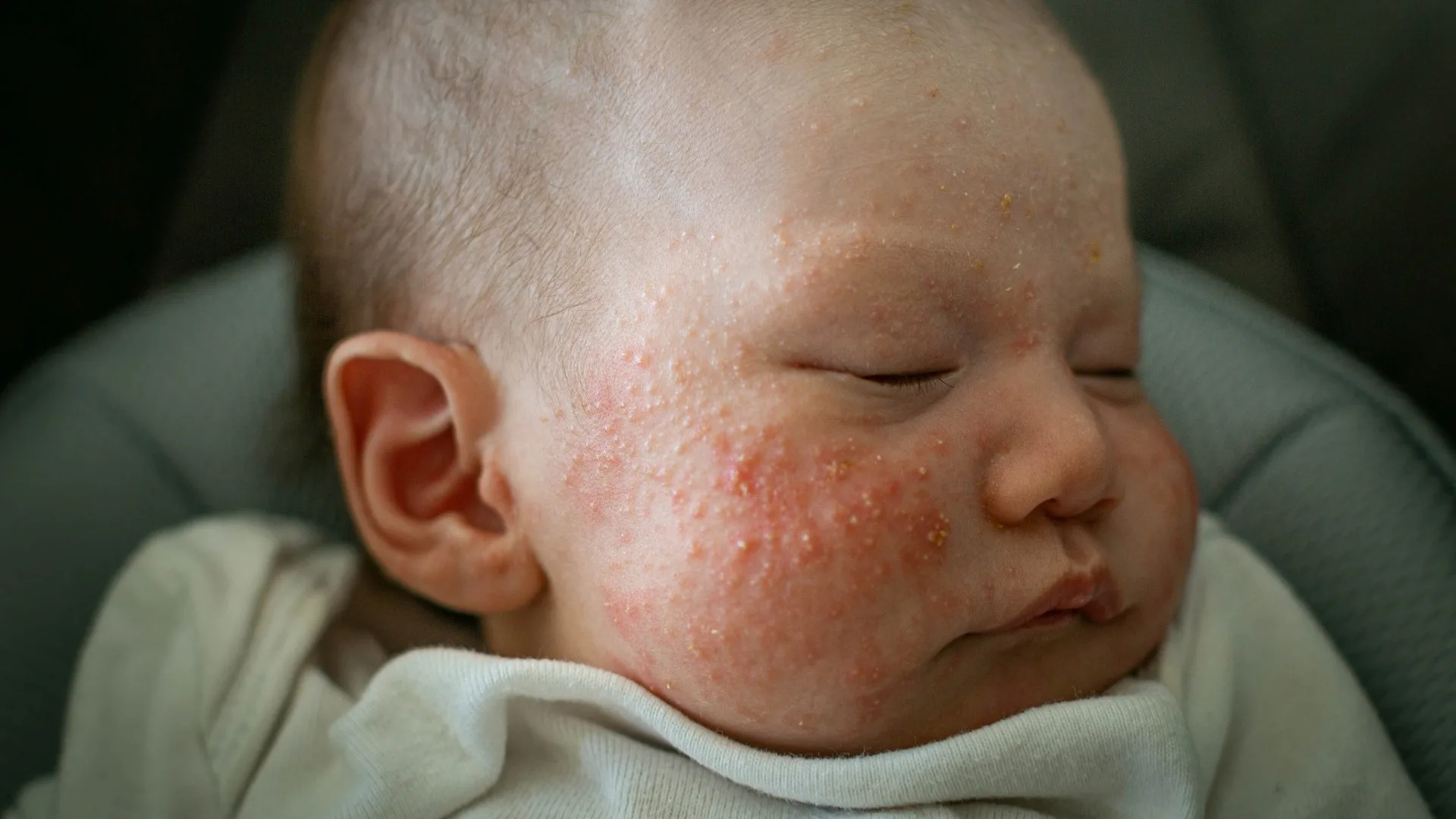 How Long Does Baby Acne Last and What to Expect Over Time