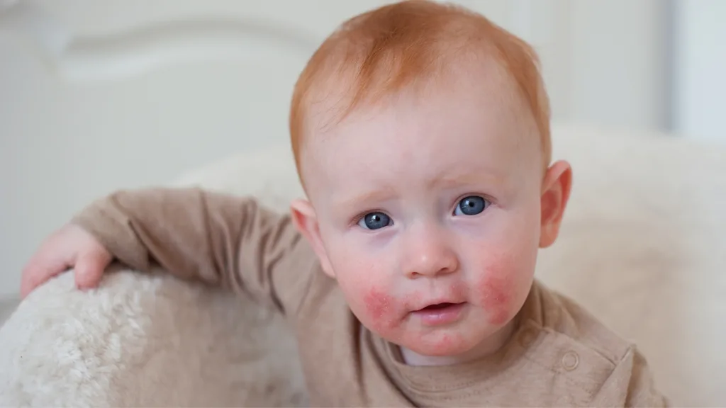 Infant Formula Allergy Symptoms and Solutions: A Parent’s Guide
