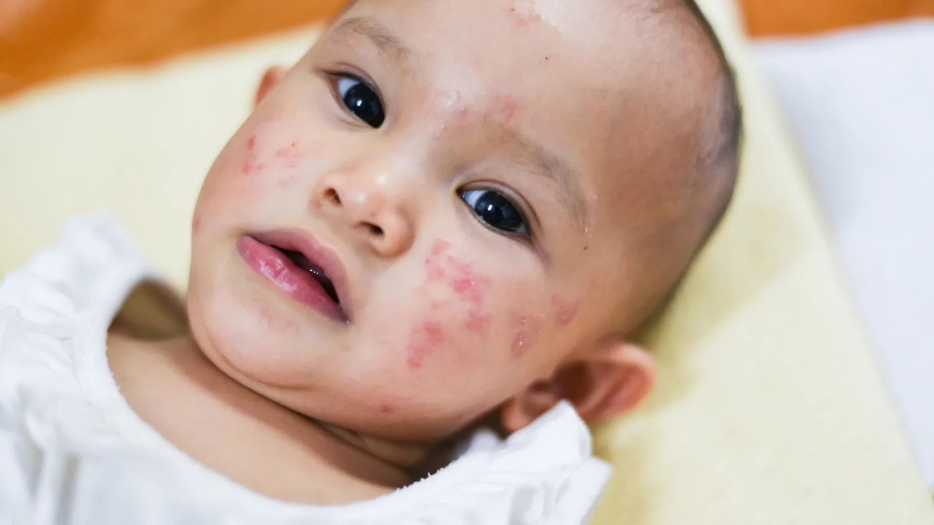 Common Signs of Infant Formula Allergy