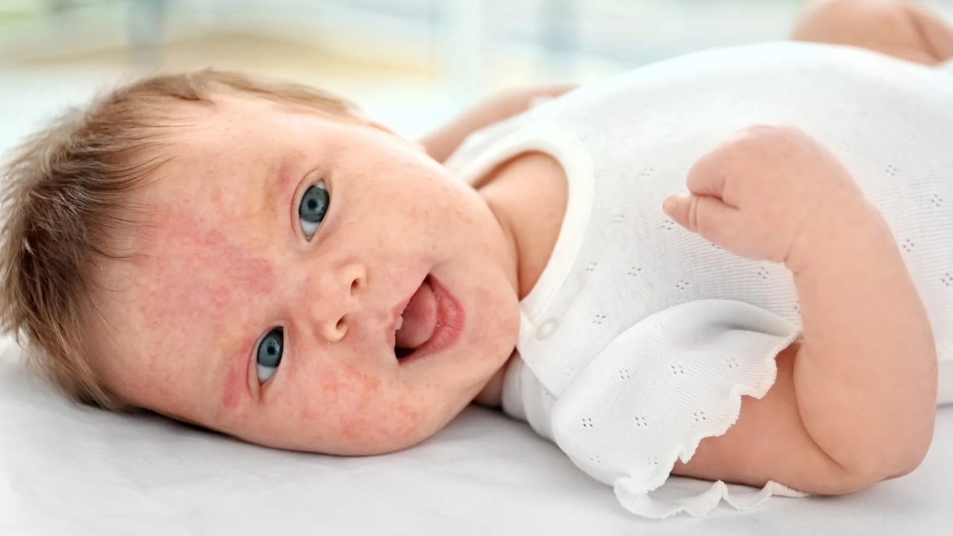 Types of Allergic Reactions to Infant Formula