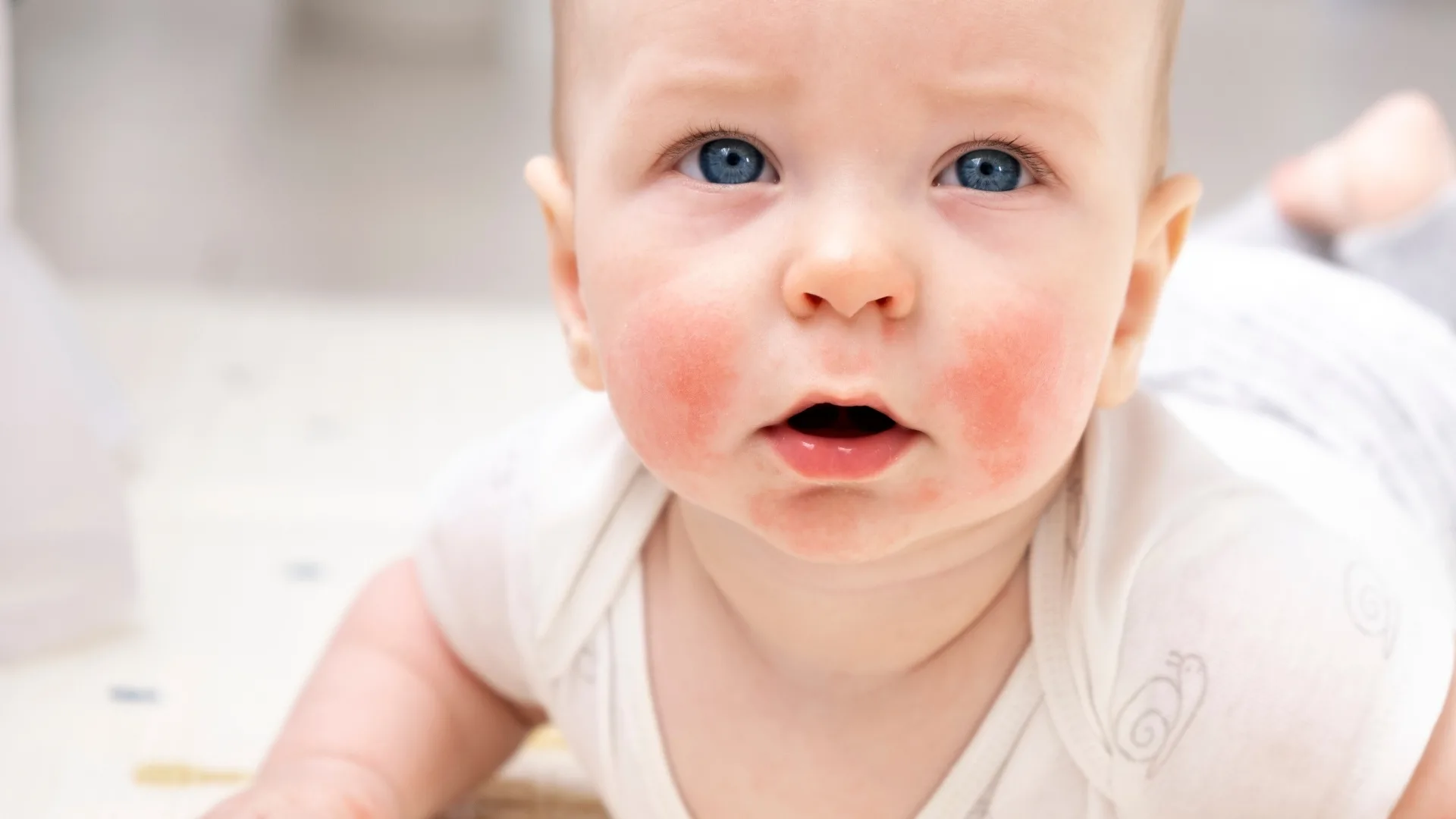 What Is Cow's Milk Allergy in Babies